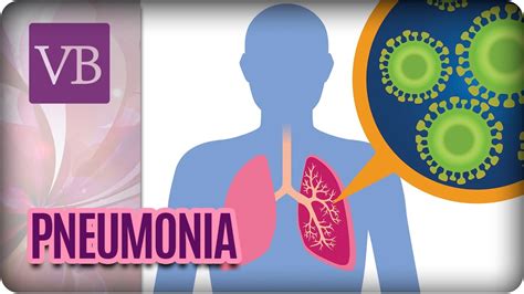 Pneumonia Sintomas Tipos E Como O Tratamento Nccpakistan Org Pk