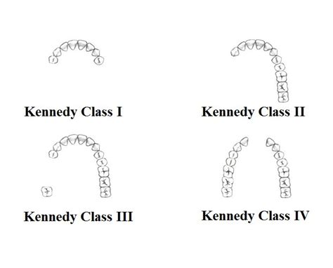 Kennedy Classification | Dental hygienist school, Dental hygienist, Dental