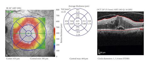 Sample Cases From Group I Case 1 A Baseline Oct Scan Of Dme With Download Scientific