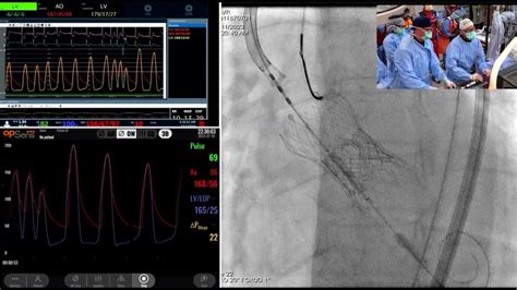 CVI 2023 Optimizing Case Efficiency And Hemodynamics YouTube