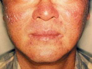 Dermatitis actínica crónica Hoogstra Centros Medicos