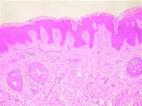 Histopathological Examination Shows Hyperkeratosis Slight