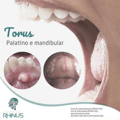 TÓRUS MANDIBULAR E PALATINO Clínica Rhinus