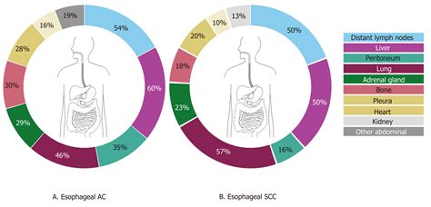 Metastatic Pattern In Esophageal And Gastric Cancer Influenced By Site