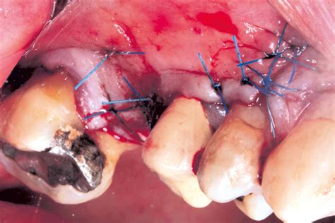 Maxillary Sinus Cyst Removal Using The Crocodile Technique And