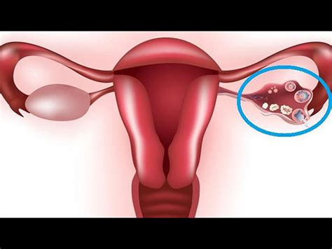 Ovarian Cysts Causes Symptoms Diagnosis And Treatment