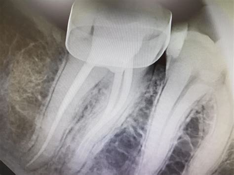 Why does my RCT hurt? *X-Ray Included* : r/Dentistry