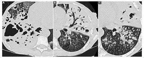 Lesiones Cavitadas Pulmonares Diagnóstico Diferencial Y Revisión