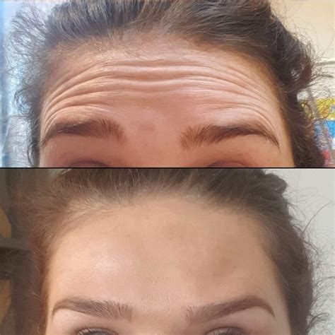 Anti Wrinkle Injections Faces By Akj Manchesters Leading Aesthetic