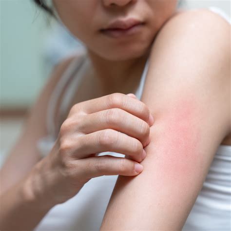 Amoxicillin Rash Forefront Dermatology