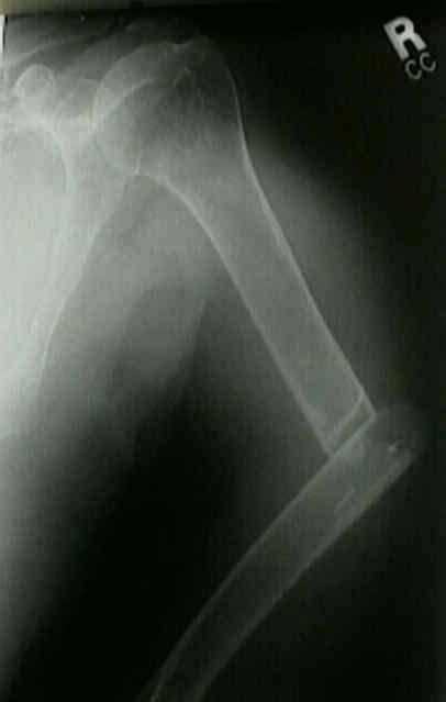 Types Of Humerus Fractures