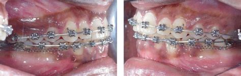 Evolution Of The Mandibular Distalization After 4 Months Of Traction