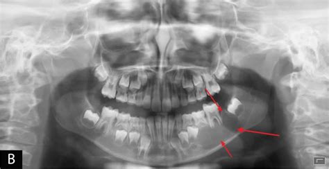 Aneurysmal Bone Cyst Causes Symptoms Diagnosis Treatment Recurrence