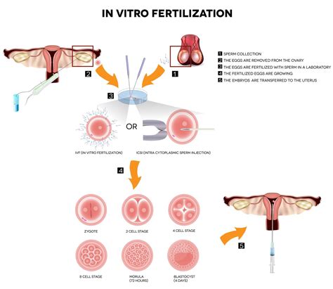 In Vitro Fertilization Dfw Center For Fertility Ivf