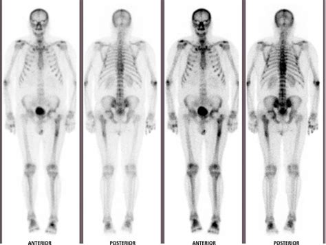 Year Follow Up Technetium M Hydroxydiphosphonate Whole Body Bone