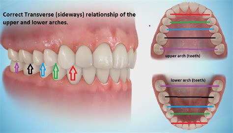 Lower Arch Expander