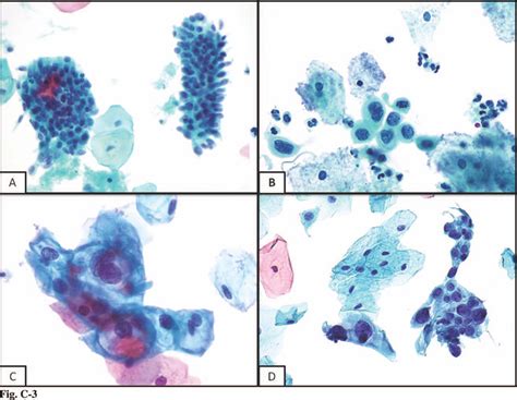 Decidual Cells May Be Mistaken For Glandular Or Squamous Atypia On