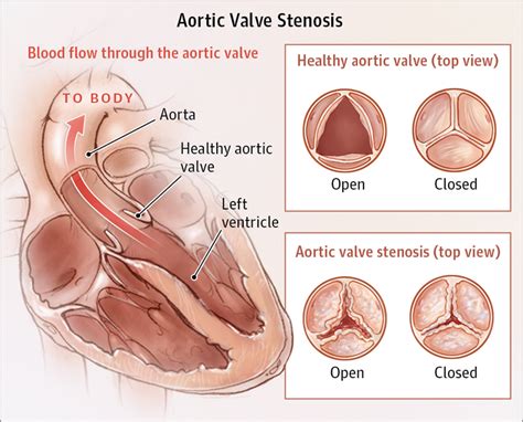 Aortic Valve Stenosis Valvular Heart Disease Jama Cardiology