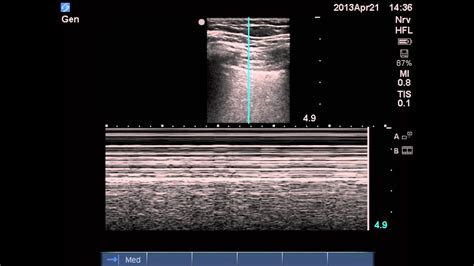 Ultrasound Diagnosis Of Pneumothorax YouTube