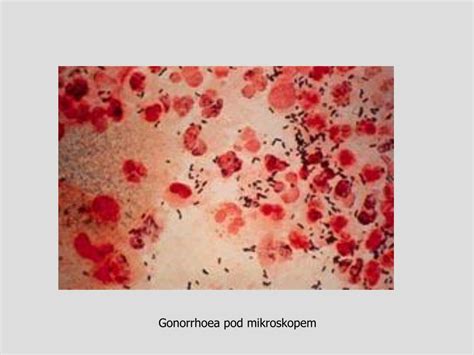 PPT - Pohlavní choroby PowerPoint Presentation, free download - ID:4380095