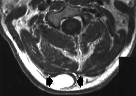 Imaging Characteristics Of Spindle Cell Lipoma Ajr