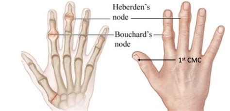 Pathology Of Msk Joint Dysfunctions Flashcards Quizlet