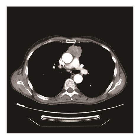 Ct Scan Cross Section Anterior Mediastinal Mass Upper Quadrant With