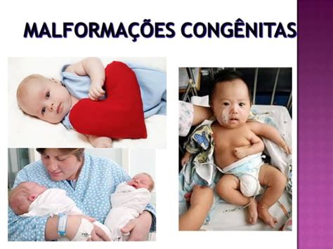 Malformações Congênitas Ppt