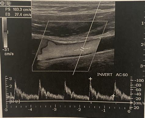 Doppler Instrumentation And Hemodynamics 501 550 Flashcards Quizlet