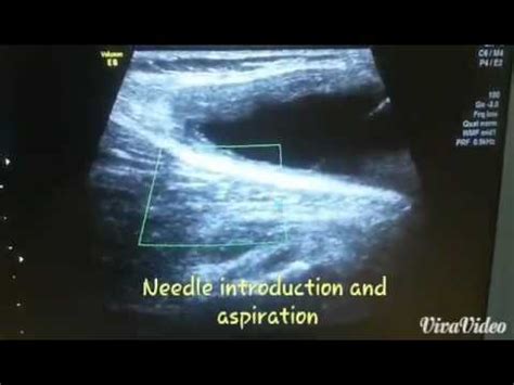 Baker S Cyst Aspiration Under Ultrasound Guidance YouTube