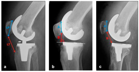 Radiographic Positioning Of The Knee