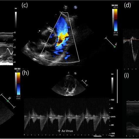 Examples Of M Mode And Doppler Echocardiographic Image A M Mode Image