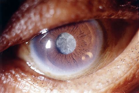 Mature Cataract Photo John Dc Anderson Published In Co Flickr