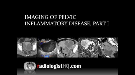 Imaging Of Pelvic Inflammatory Disease Part I Youtube