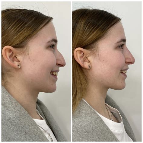 Non Surgical Rhinoplasty Nose Filler Derma Models