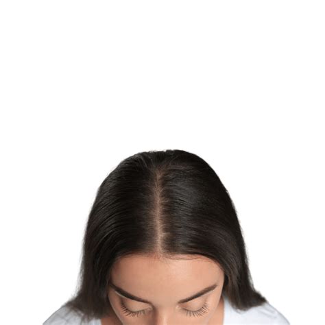 Female Pattern Hair Loss Melbourne Skin And Dermatology Clinic