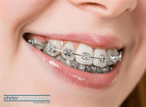 Discover The Benefits Of Braces Ehrler Orthodontics