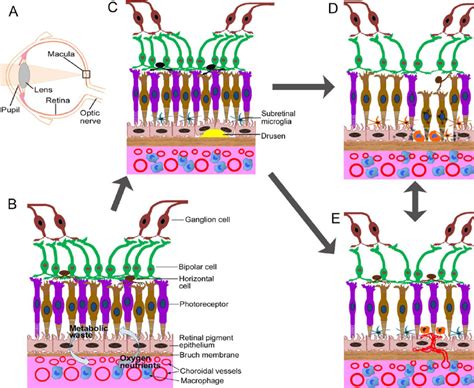 Retina And Rpe Choroid In Normal Early And Late Amd A Diagram Of A