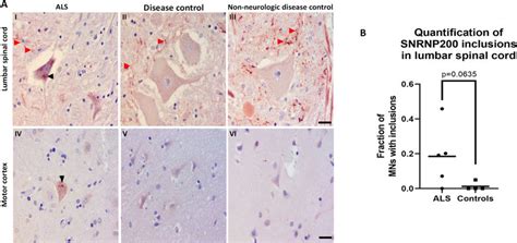 Snrnp Was Identified In Cytoplasmic Inclusions In Als Post Mortem