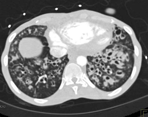 Bronchiectasis And Mucoid Impaction With Cystic Fibrosis Chest Case