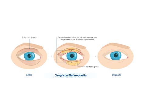 Listado de 9 blefaroplastia un ojo más grande que el otro ABeamer