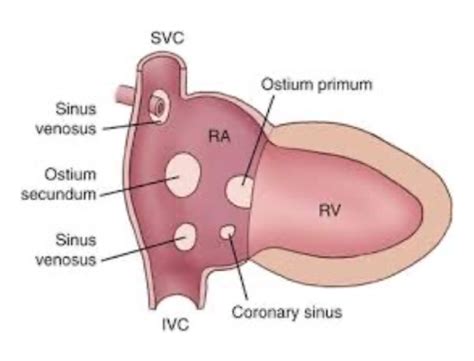 Congenital Heart Defects Flashcards Quizlet