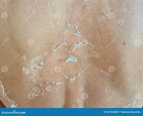 Peeling Skin After Sunburn On Back Human Skin With Dry Flaky Skin