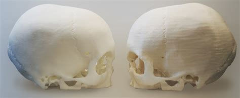 Skulls Printed In 3d From A Ct At Huddersfields 3m Bic