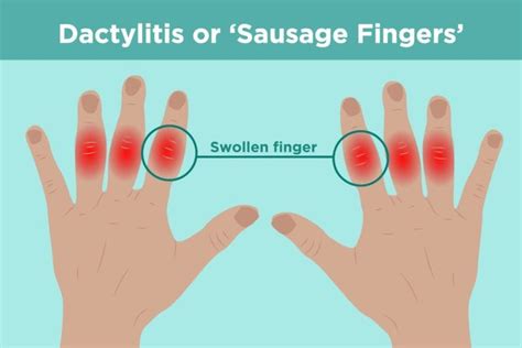 Was ist Daktylitis? Ursachen, Symptome und Behandlungen verstehen ...