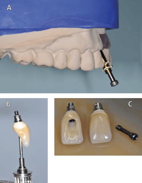 Understanding Implant Abutment Connection Interfaces