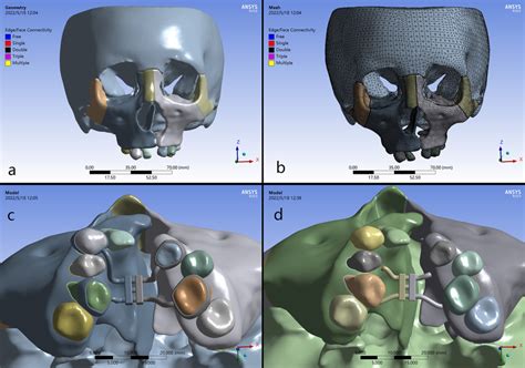 Geometrical Models Of The Craniofacial Structures And Rapid Maxillary