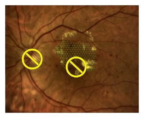 OCT- versus RM-SLO-guided treatment plan for macular laser ...