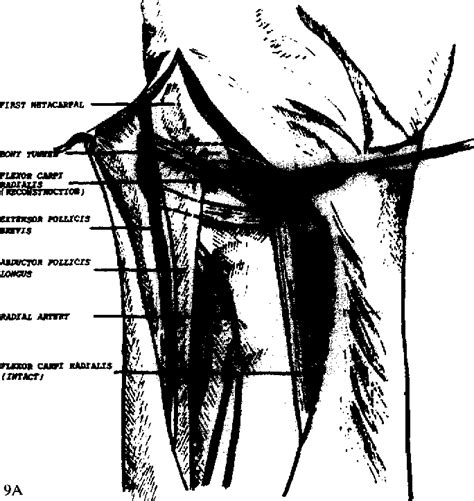 Figure 8 from Dislocation of the Carpometacarpal Joint of the Thumb | Semantic Scholar