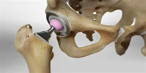 Your Hip Labral Tear Recovery A Timeline Overview